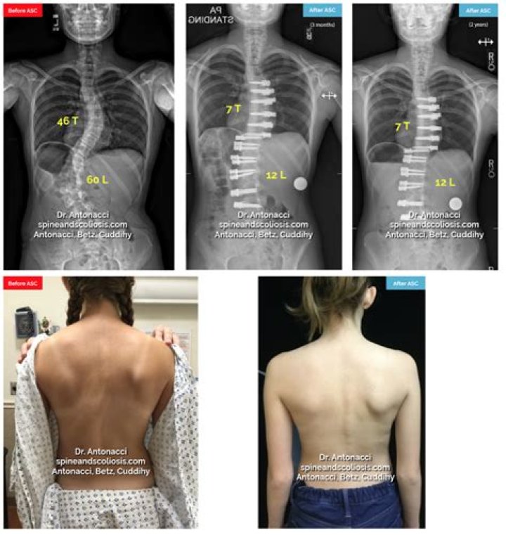 Can thoracic scoliosis be corrected?