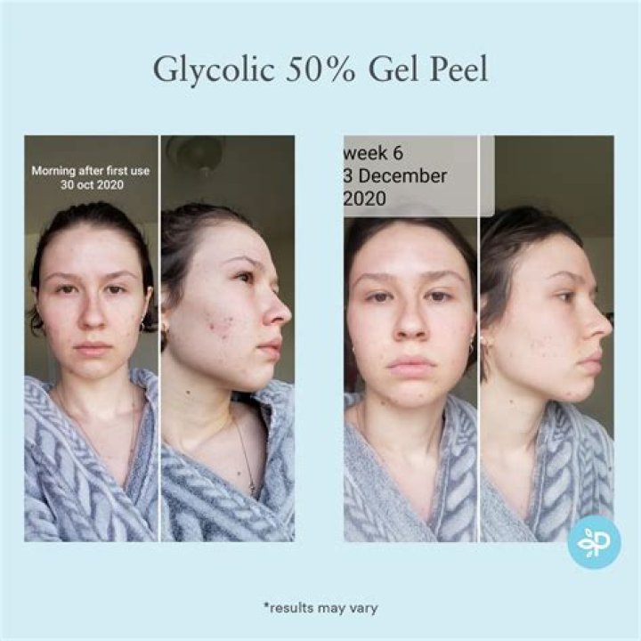 How do you use 70 percent glycolic acid peel?