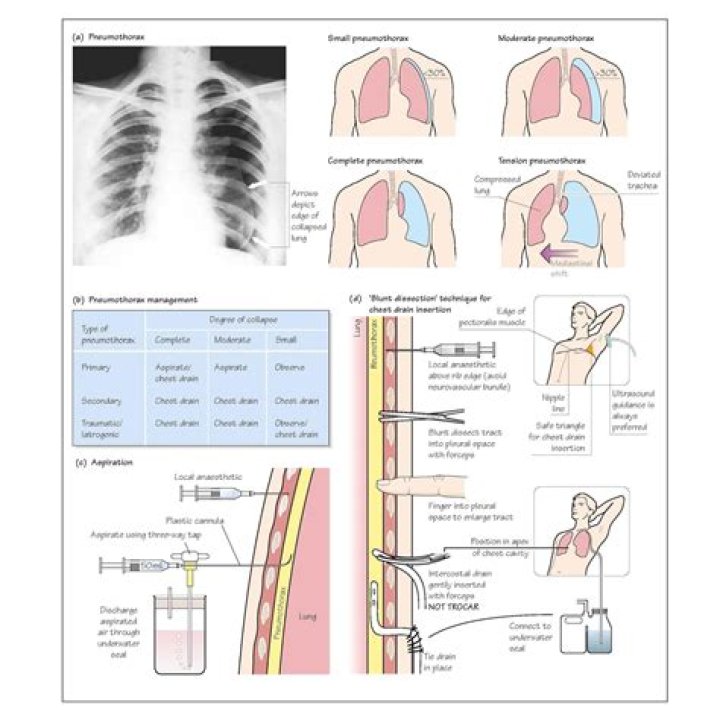 How is primary spontaneous pneumothorax treated?