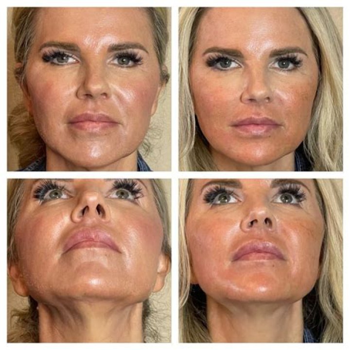 How long does a CACI face lift last?