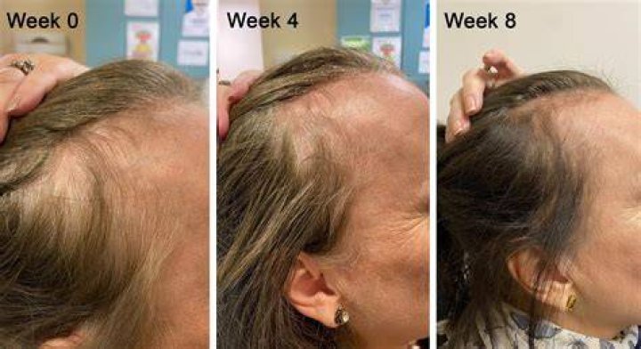 Is hair loss from diabetes permanent?