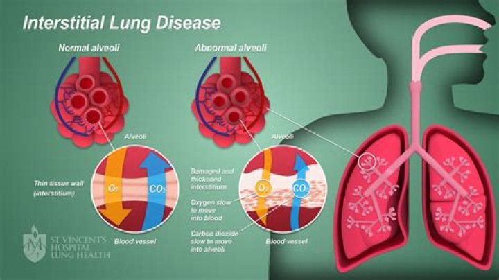 Is interstitial lung disease a terminal illness?
