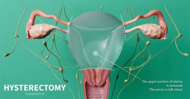 Is oophorectomy a major surgery?