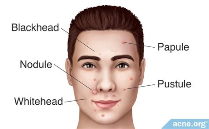 What are face nodules?