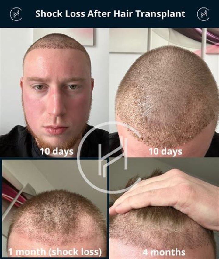 What can I do for uncontrollable hair loss?