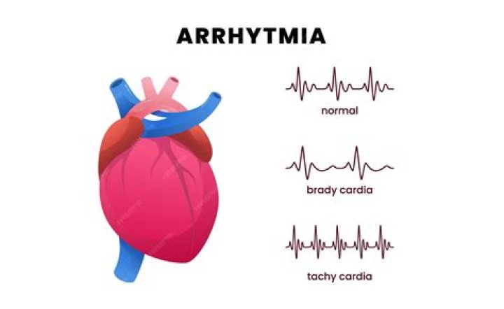 What is a pacemaker arrhythmia?