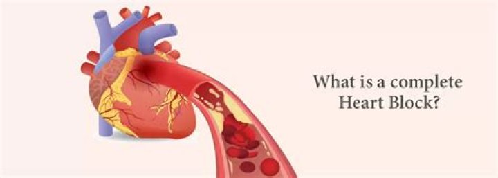 What is the most common cause of complete heart block?